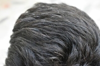 Premature Graying